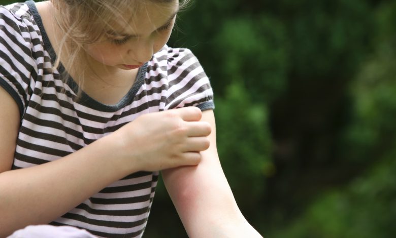 Por que as picadas de mosquito de algumas pessoas coçam mais do que as de outras? Novo estudo sugere resposta