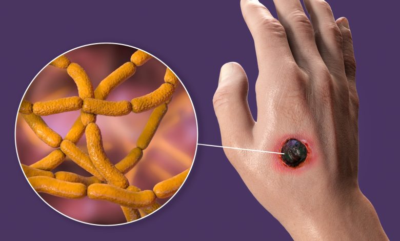 Ilustração médica mostrando a mão de uma pessoa no lado direito da imagem. A mão tem uma bolha preta no centro e cercada por pele vermelha e inflamada. Uma bolha estourada está saindo da bolha que mostra um aglomerado de Bacillus anthracis, que são estruturas em forma de bastonete.