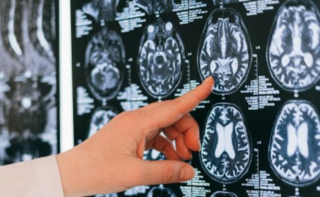 Pesquisadores encontram conexão entre Alzheimer e poluição luminosa noturna